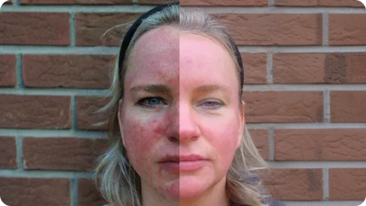 Before-and-after images showing changes in facial redness associated with rosacea.