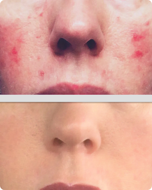 Before-and-after images showing changes in acne and blemishes.