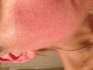 does this look like demodex? It doesnt itch at all. It will often die down to slightly pink spots but will always re-enflame again. Sorry but I dont know why its pulling in the pic sideways so please turn your computer