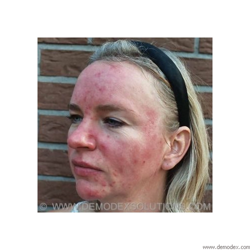 Acne rosacea