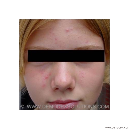 Teenager acne