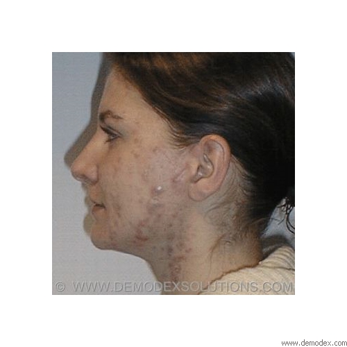 Cystic acne