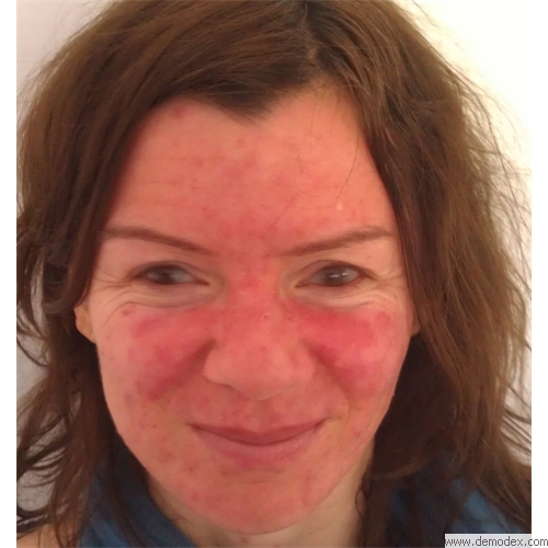 rosacea