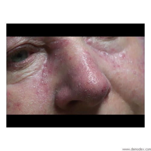 Rosacea