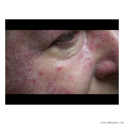 Rosacea