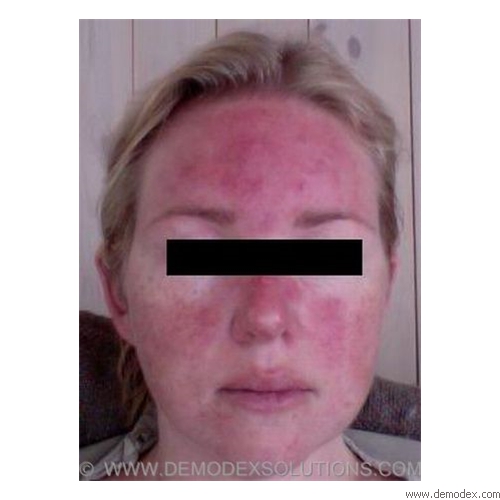 Rosacea