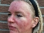 Acne rosacea