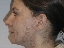 Cystic acne