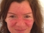 rosacea