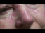 Rosacea