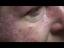 Rosacea