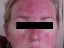 Rosacea